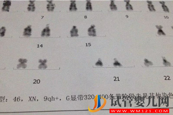 9号染色体异常可能会引起膀胱癌
