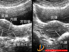 薄型子宫内膜临床表现和诊断标准汇总，及时发