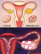 多囊卵巢综合症做试管婴儿要注意什么?